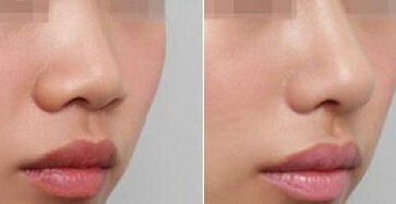 膨体隆鼻价格解析