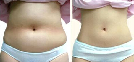 腹部吸脂能去妊娠纹吗