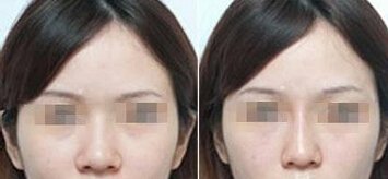 成都膨体隆鼻具体有什么特点
