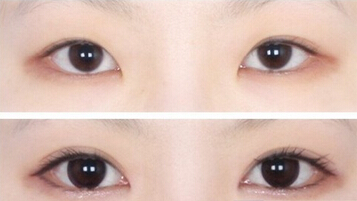 眼部整形有哪些项目