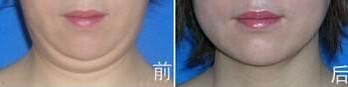 如何处理双下巴