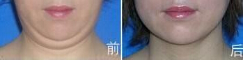 双下巴整形好吗