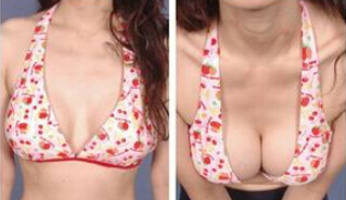 一生能做几次丰胸手术