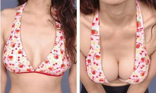 成美丰胸技术好在哪