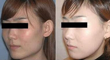 颧骨整形好在哪里