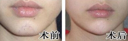 下巴短如何变长