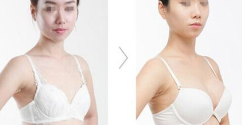 丰胸整形手术效果怎样
