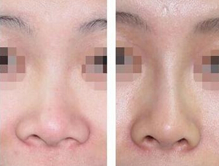 玻尿酸隆鼻风险高吗