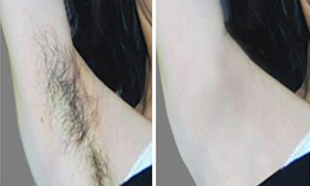 激光脱汗毛安全吗