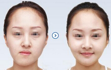 如何把方脸变成鹅蛋脸