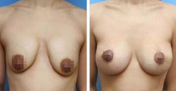 做乳晕缩小术该注意什么