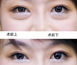 女人眼袋怎么消除