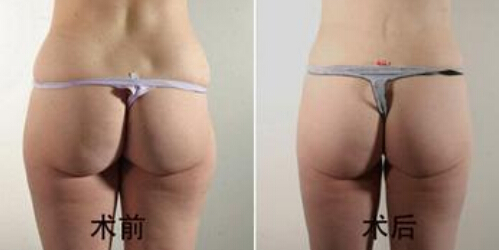 臀部吸脂技术怎么样