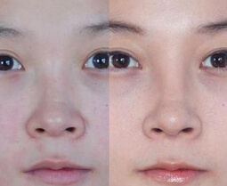 隆鼻后消肿有什么技巧