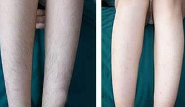 男人做激光脱毛有副作用吗