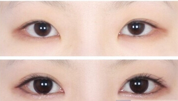 双眼皮手术失败了怎么修复