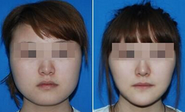 大脸怎样变小脸