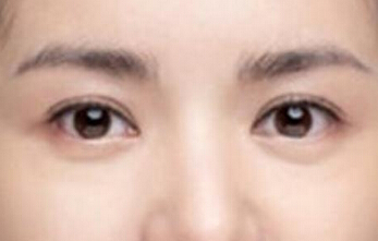 光子嫩肤治黑眼圈好么