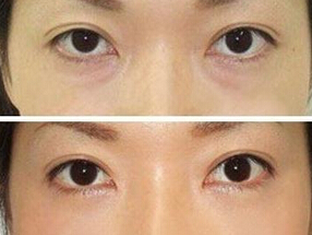 光子嫩肤去黑眼圈管用吗