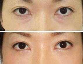 怎么去除黑眼圈极有效