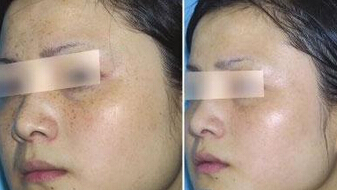 过敏性肌肤可以做彩光嫩肤吗
