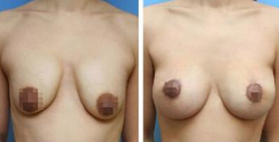 乳晕太大如何处理