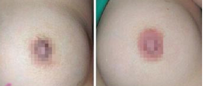 乳头乳晕再造效果自然吗
