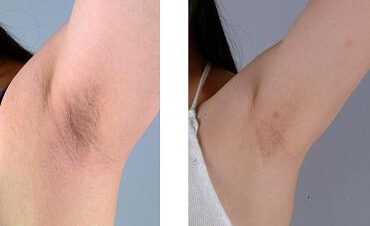 女人如何去除体毛