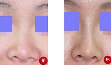 自体脂肪隆鼻疗效如何呢