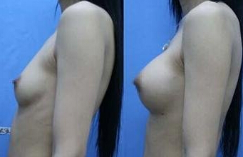 自体脂肪隆胸要做几次呢
