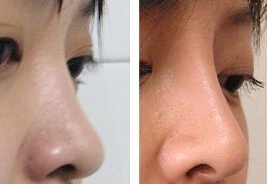 爱贝芙注射隆鼻有哪些优点
