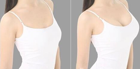 一般隆胸后能母乳喂养吗