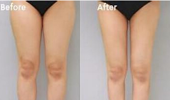 大腿抽脂后要怎样护理