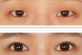 做韩式双眼皮多少钱