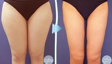 腿部抽脂会反弹吗