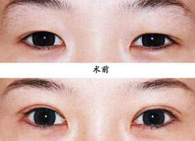 一般眼皮抽脂多少钱