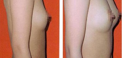 脂肪丰胸适合哪些情况