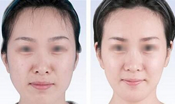 削骨瘦脸真的有那么好吗