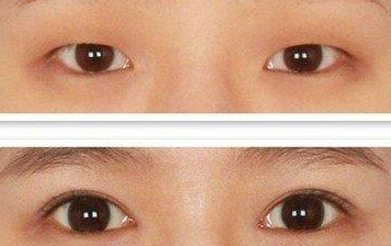 做割双眼皮会有伤疤吗