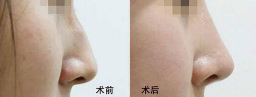 驼峰鼻整形效果好不好