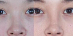 怎样让鼻子变高
