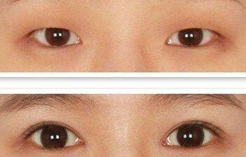 成都做双眼皮效果好吗