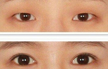 做双眼皮手术的风险大么