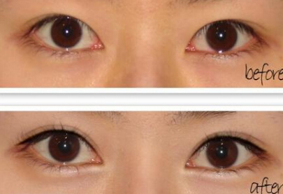近视眼能割双眼皮吗
