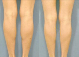 小腿吸脂要注意什么