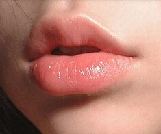 玻尿酸丰唇改唇