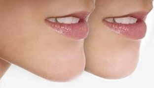 假体丰下巴的价格