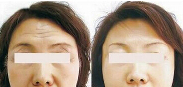 保妥适去抬头纹