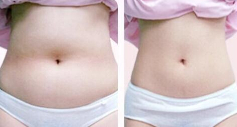 腰腹部吸脂后的效果图