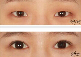 单眼皮女生做双眼皮好吗